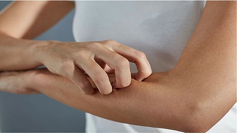 लॉकडाऊनमध्ये सोरायसिस बळावतोय, रूग्णांनो अधिक काळजी घ्या