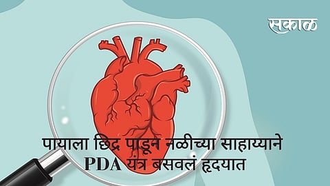 पायाला छिद्र पाडून नळीच्या साहाय्याने PDA यंत्र बसवलं हृदयात; हृदयविकाराच्या दुर्मिळ आजारावर यशस्वी सर्जरी