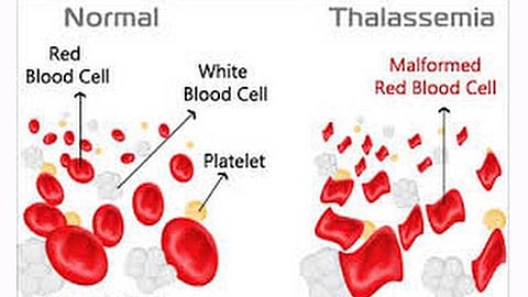thalassemia