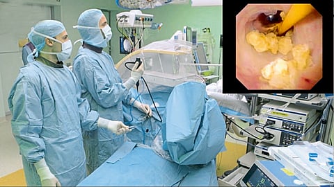 ureteroscopy