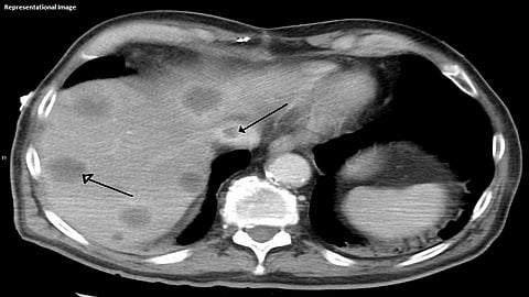 10 लाखांतून एकाला होणारा दुर्मिळ आजार,  मुंबईकर स्वप्नीलला हवीये तुमच्या मदतीची गरज