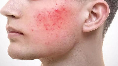 त्वचाविकार : जाणून घ्या रोसासियाच्या चार प्रकारांविषयी