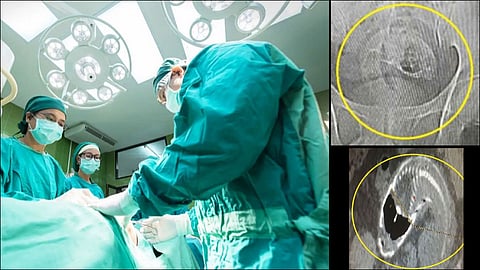 doctors remove dead fish from chinese man video viral