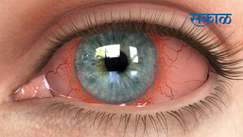 home remedies for eye syndrome nagpur news