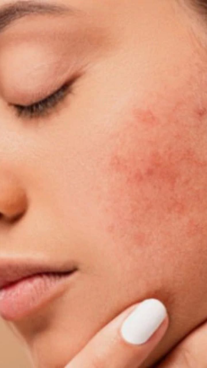 Pimples Causes | झोपण्याच्या या सवयींमुळे चेहऱ्यावर येतात पिंपल्स
