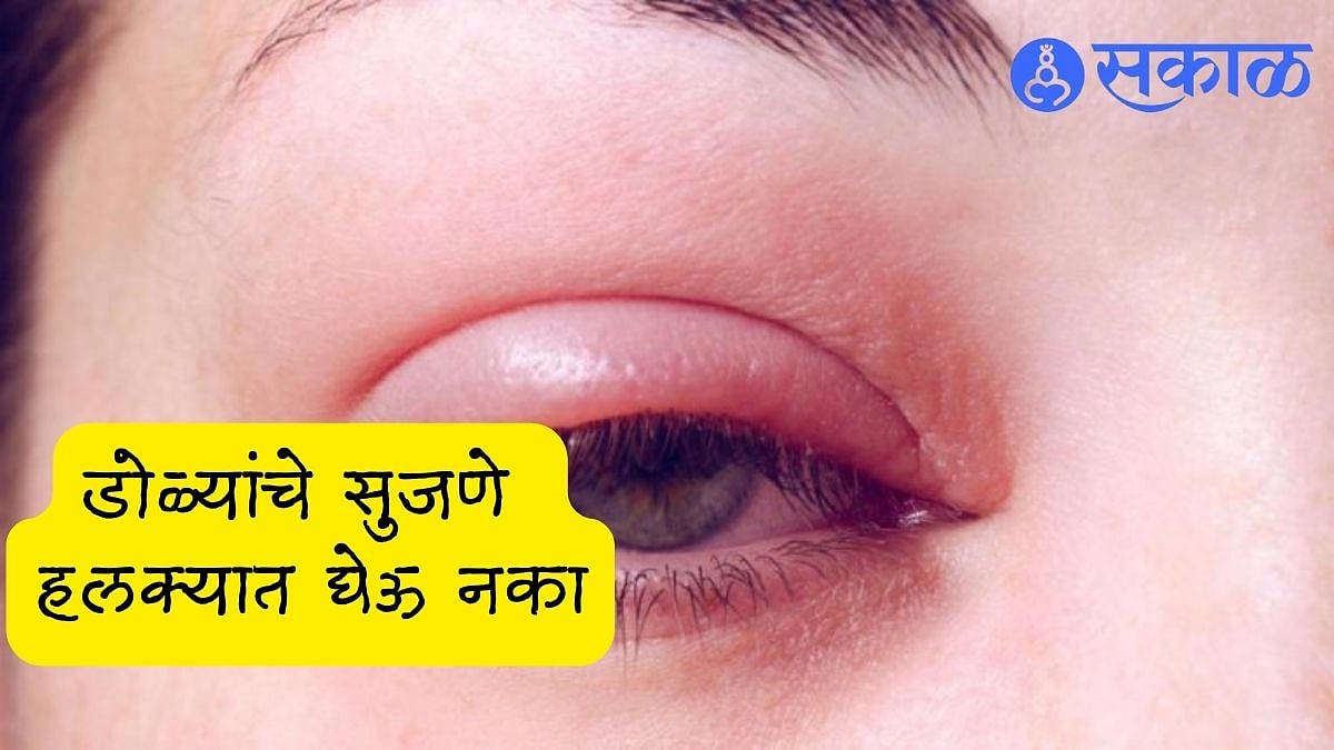 Eye Care Tips डोळ्यांचे सुजणे हलक्यात घेऊ नका; वेळीच उपाय करा नाहीतर