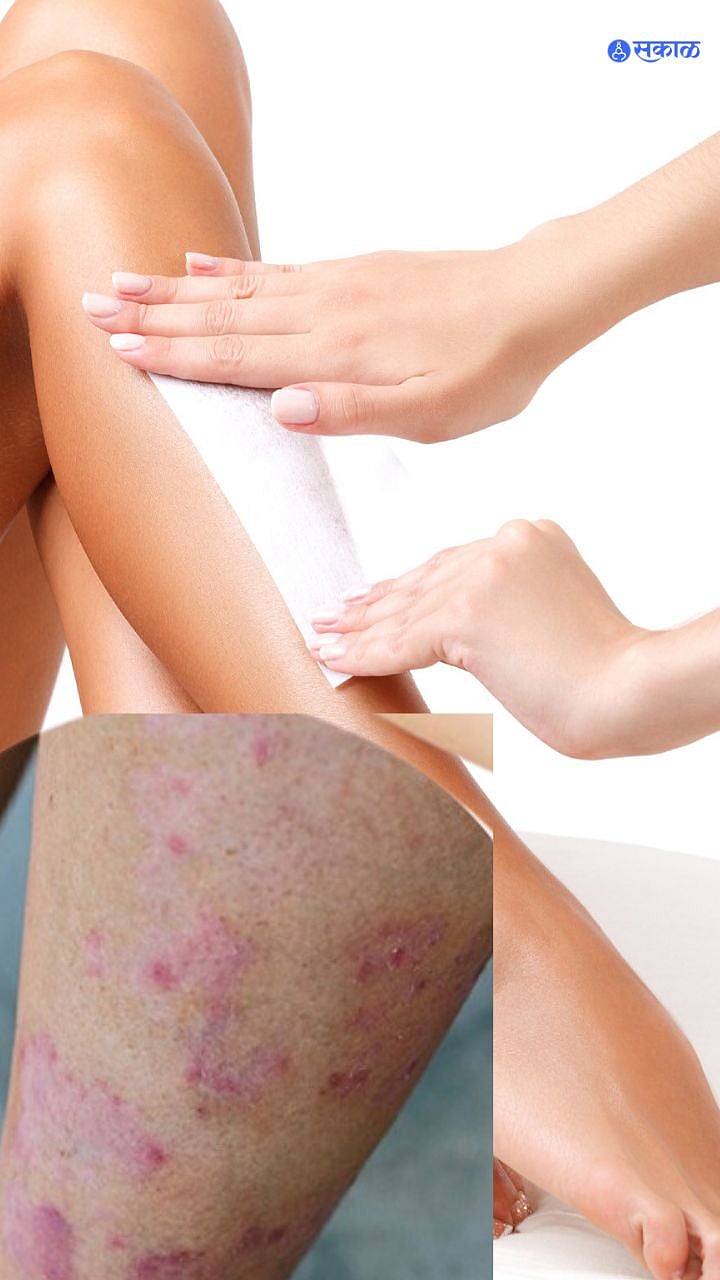 Rash After Waxing : व्हॅक्सिंगनंतर त्वचेवर रॅश येते? घ्या ही काळजी