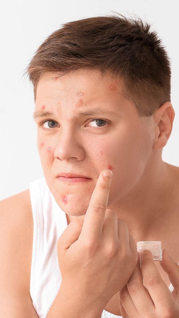 चेहऱ्यावरचे पिंपल्स 'हे' कमी करण्यासाठी काय खावे? how to remove pimples ...