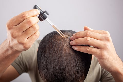 Minoxidil for hair loss