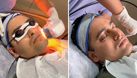 Should Your Get a photofacial treatment