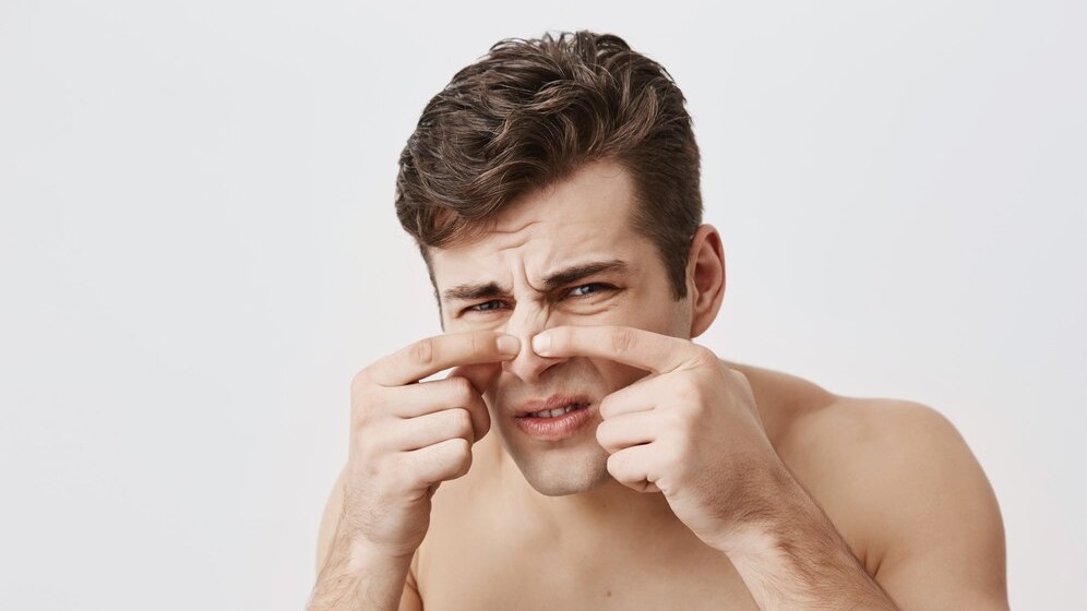 ब्लॅकहेडने त्रस्त आहात? 'या' दोन पदार्थांनी घरातच बनवा रिमुव्हर पॅक आणि मिळवा स्वच्छ त्वचा