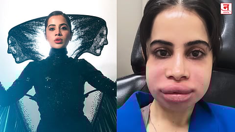 Uorfi Javed : ओठ सुजले, चेहरा झाला लालेलाल... 'लिप फिलर'नंतर उर्फी जावेदचा इन्स्टा व्हिडीओ चर्चेत