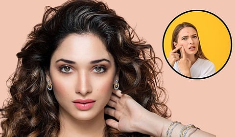 तमन्ना भाटियाचा 'थुंकी' उपाय : खरंच सकाळची लाळ मुरुमांवर उपयोगी आहे का? जाणून घ्या तथ्य