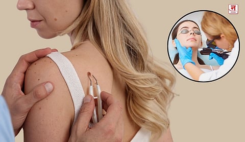 चामखीळ : दिसायला किरकोळ पण त्रासदायक त्वचारोग; जाणून घ्या घरगुती आणि वैद्यकीय उपाय