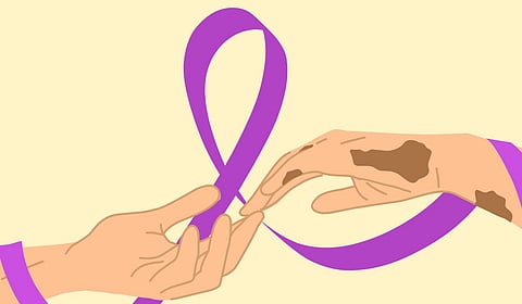 कुष्ठरोग आता ‘नोटिफायबल डिसीज’; डॉक्टरांना  २ आठवड्यांत अहवाल देणे बंधनकारक, २०२७ पर्यंत ‘कुष्ठरोगमुक्त महाराष्ट्र’चे लक्ष्य  