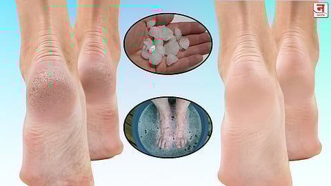टाचांना पडलेल्या भेगा होतील गायब! फक्त १० रुपयांच्या तुरटीने मिळवा मुलायम पाय