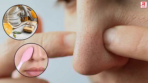 ब्लॅकहेड्समुळे जातेय चेहऱ्याची शोभा? घरच्या घरी करा 'हे' सोपे उपाय अन् मिळवा नितळ त्वचा 