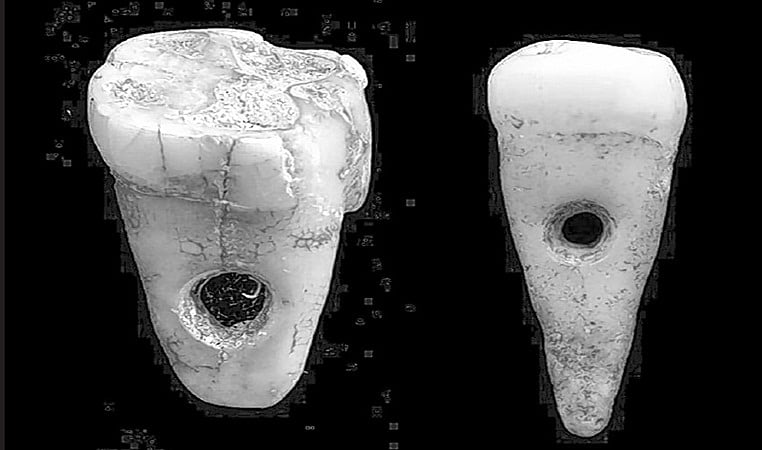 8,500-year-old pendant made from human teeth discovered