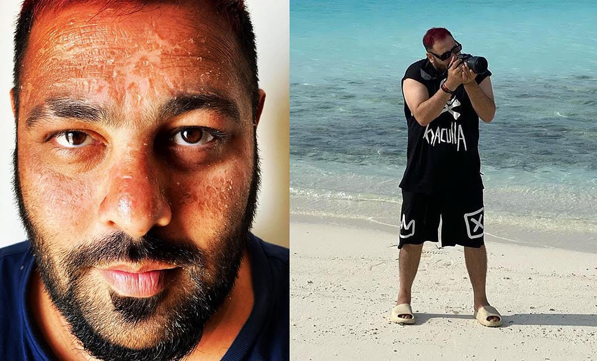 B-town shocked after rapper Badshah shares a sunburnt picture of himself