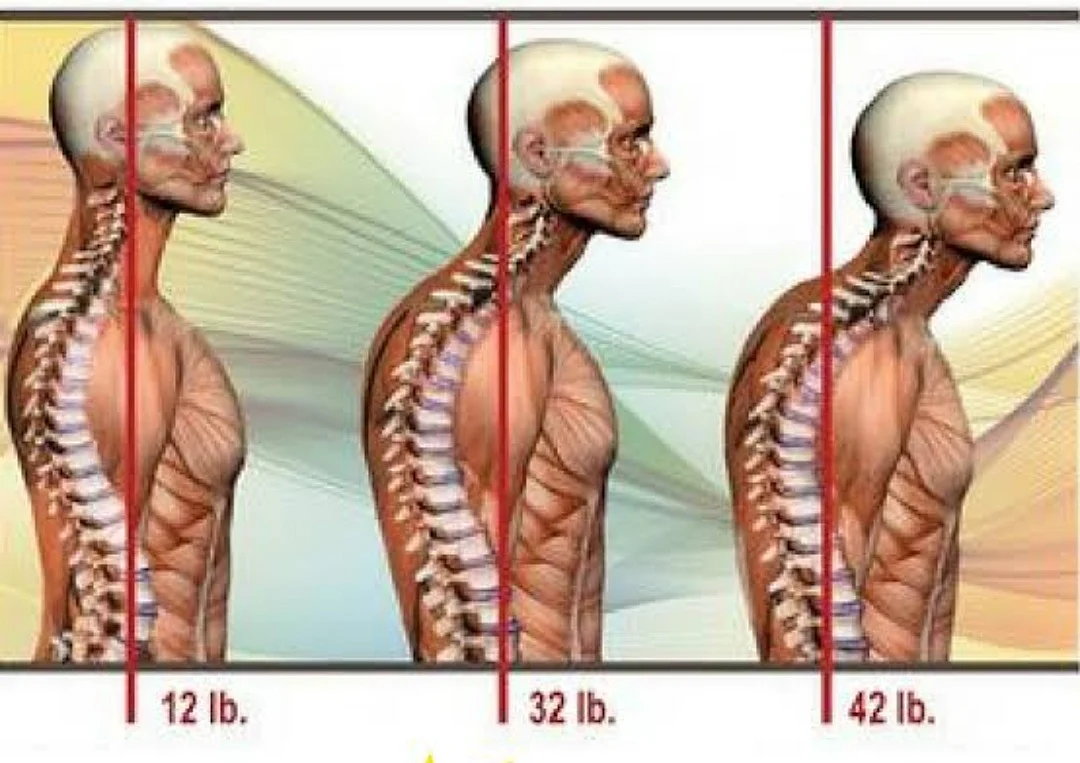 Every inch of increase of forward head posture increases weight of the head by 10 pounds