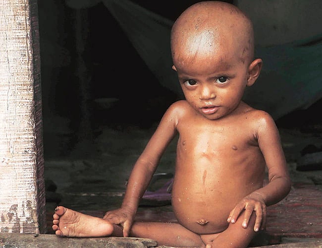 'Mukhyamantri Suposhan Abhiyan' cured nearly 1.41 lakh malnourished children in Chhattisgarh: Govt
