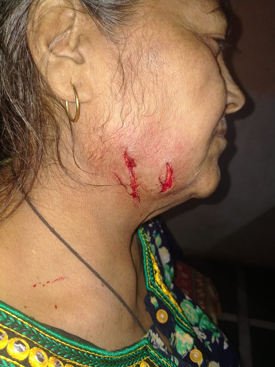 September 29: Nirmaladevi Rambadan Singh (55) was attacked by the leopard when she was sitting in front of her house at Visava Workers Colony in Aarey. Singh used her walking stick to fight back. She was clawed on her jaw and her back.