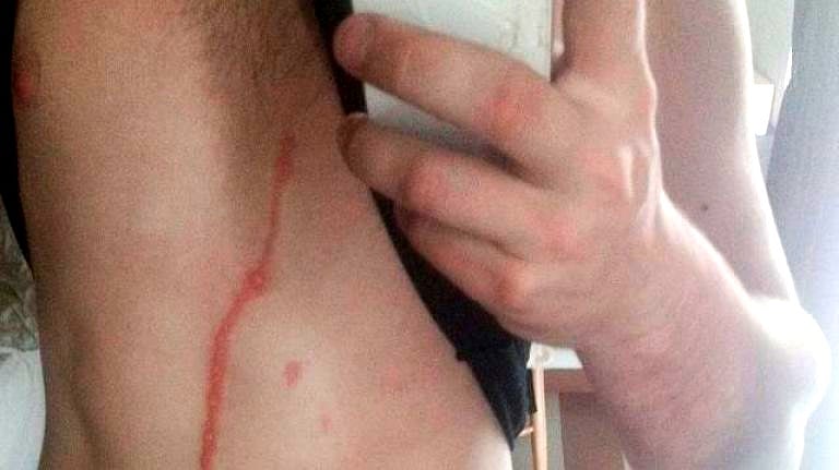 Man discovers spider living under his skin for 3 days during vacation