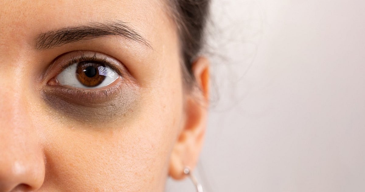 Worried of dark circles? 5 Ways to treat your skin right