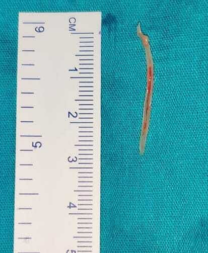 After a long surgical procedure, the 2.8-cm-long bone was removed