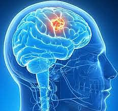  Jabalpur: School of Excellence in Neurosurgery to be functional soon