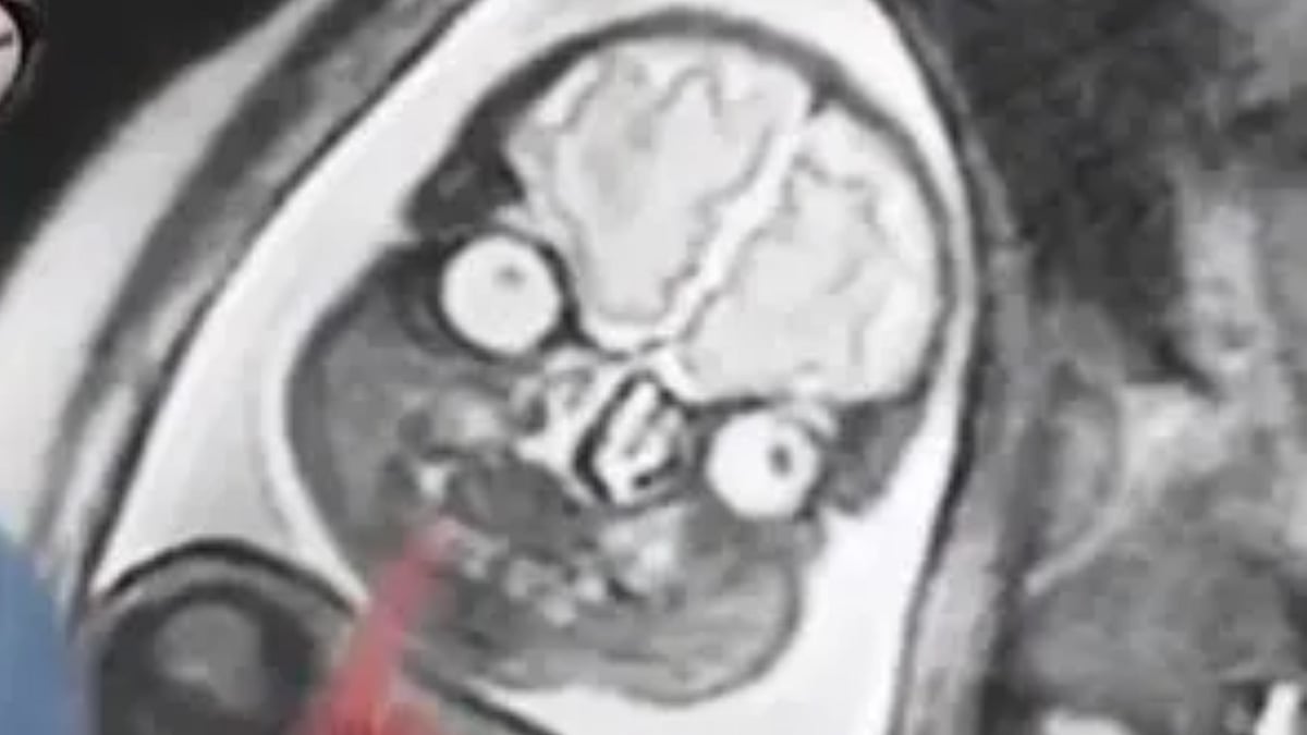 Aliens? No, that's how babies in womb pose for MRI scan