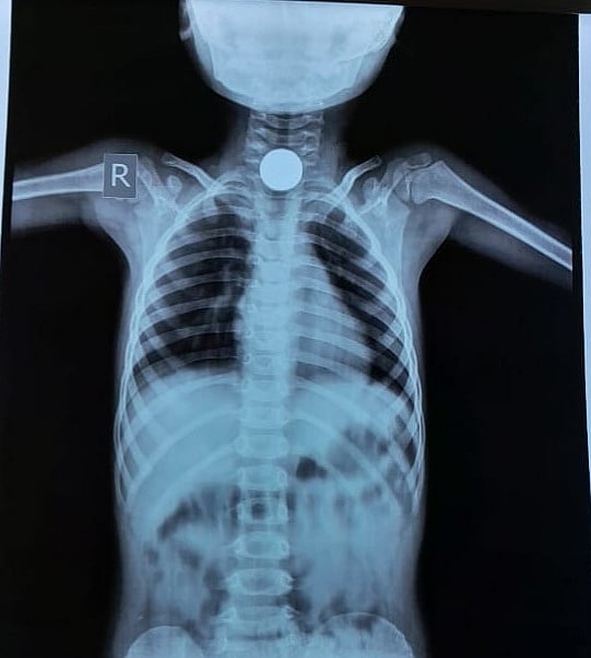 X-ray report of boy showing coin stuck in the upper part of the food pipe | 