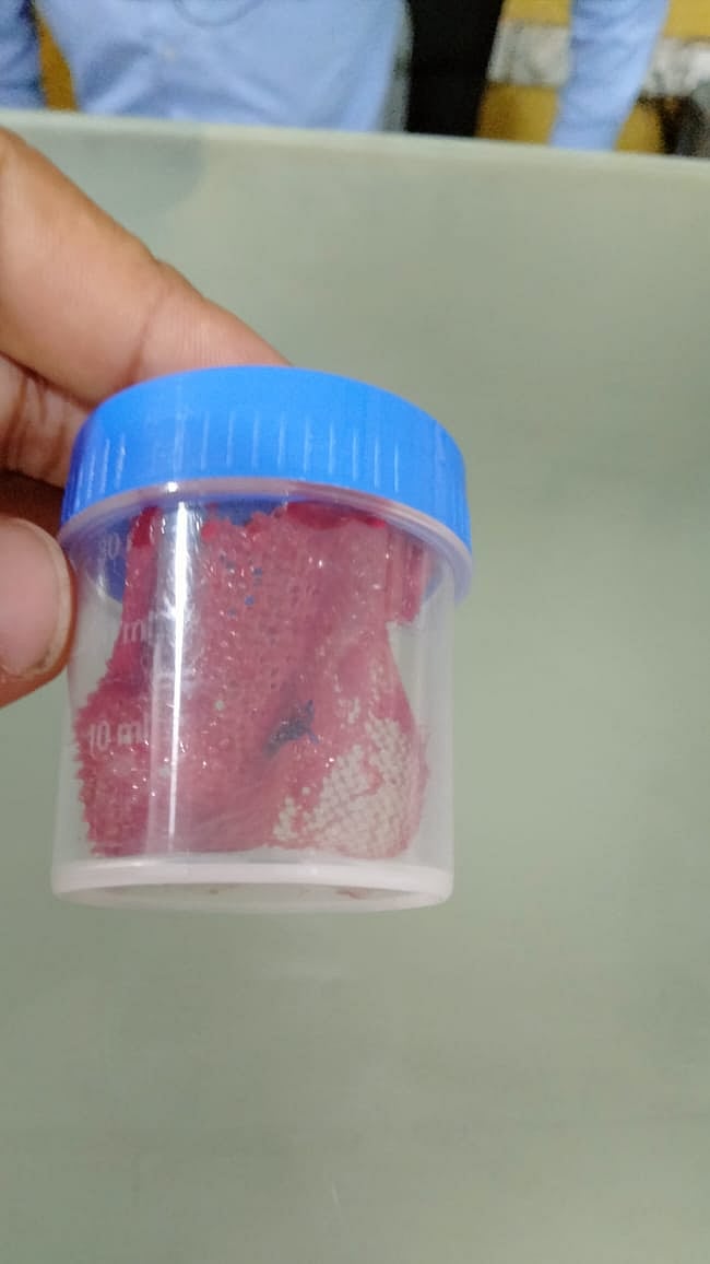 Mesh which left in patient's stomach during operation