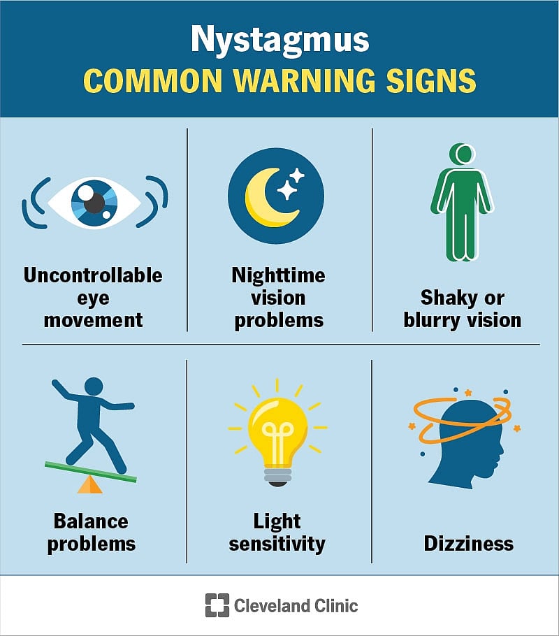 Warning sings of Nystagmus | Cleveland Clinic