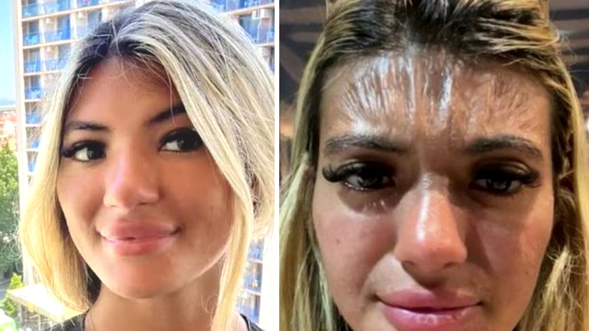 Sunbathing gone wrong! Woman receives temporary 'plastic forehead' after 30 minutes sun exposure at Bulgarian beach