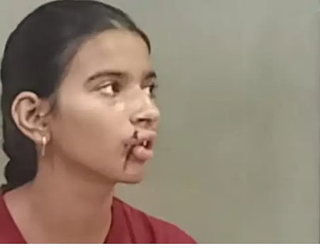Bhopal: Teen shuttler injured in stone pelting