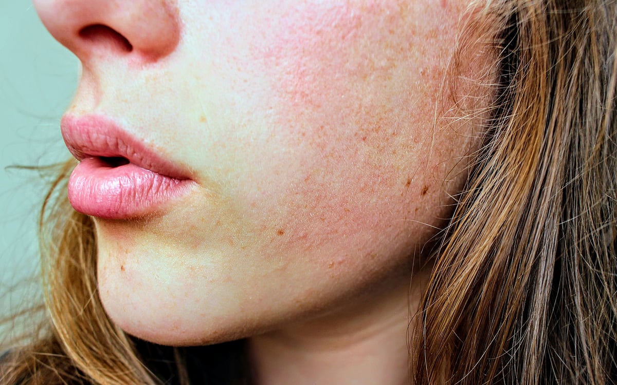 Dry skin