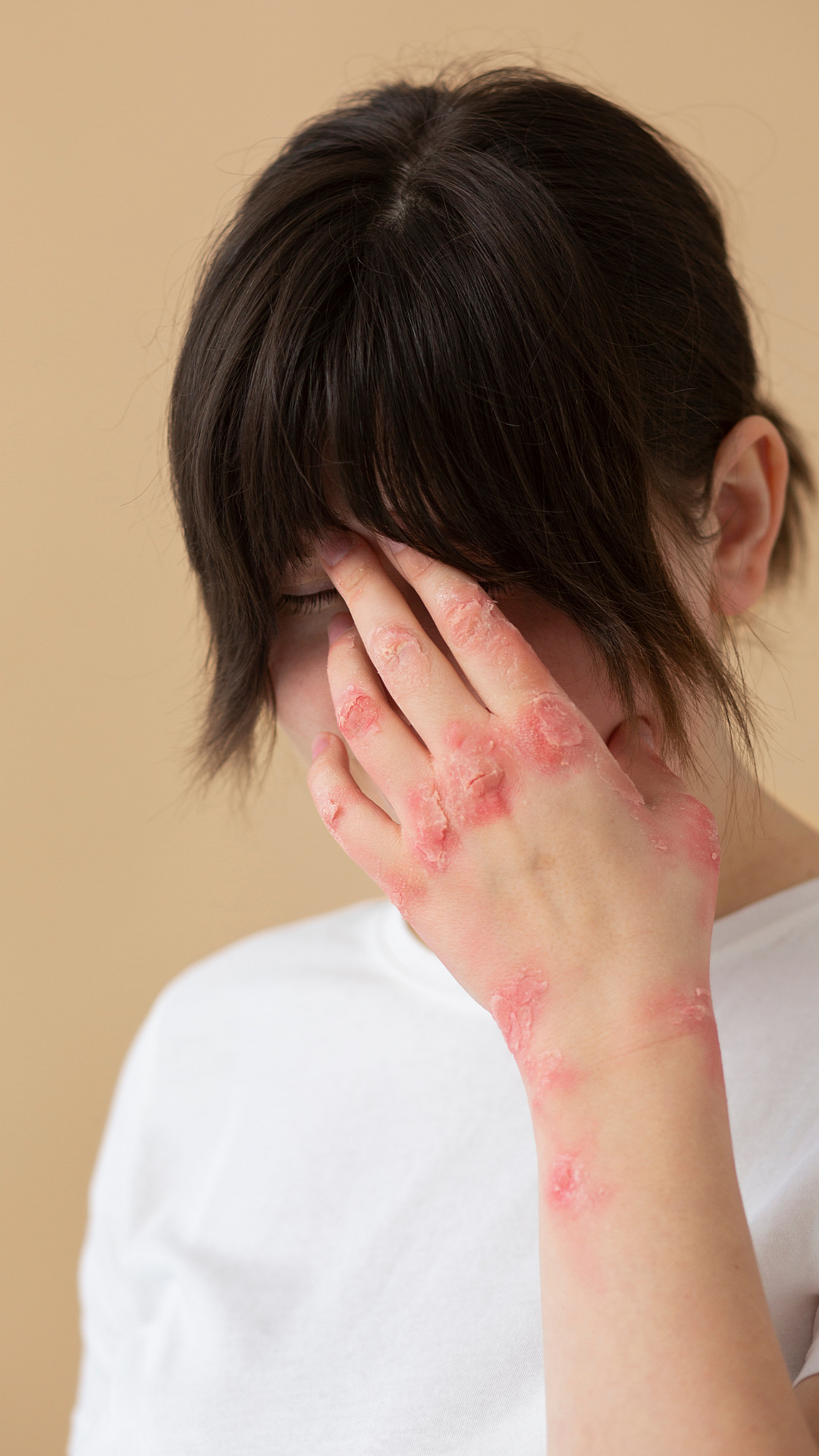 Heals skin wounds: Curry live paste can be applied to burns, bruises and skin eruptions as a treatment. The antiseptic properties help healing the injuries including bee stings and bites of poisonous reptiles. Curry leaves also help treat mouth ulcers