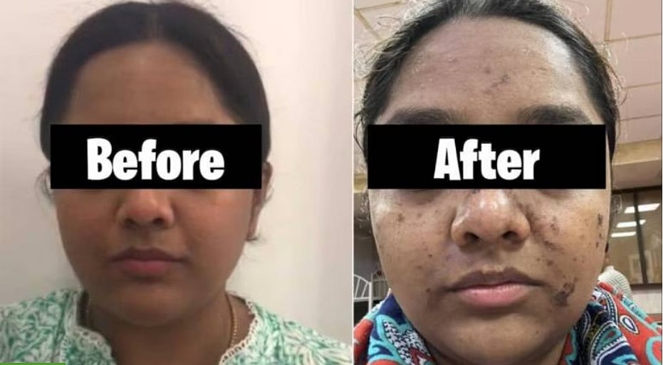 Mumbai: Woman Suffers Burn Marks On Face After Paying ₹17,500 For Facial; FIR Against The Salon