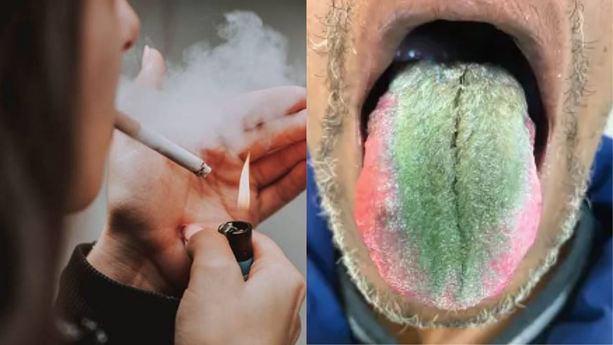 Oh, No! US Man Develops Hairy, Green Tongue Due To Smoking; Picture Goes Viral 