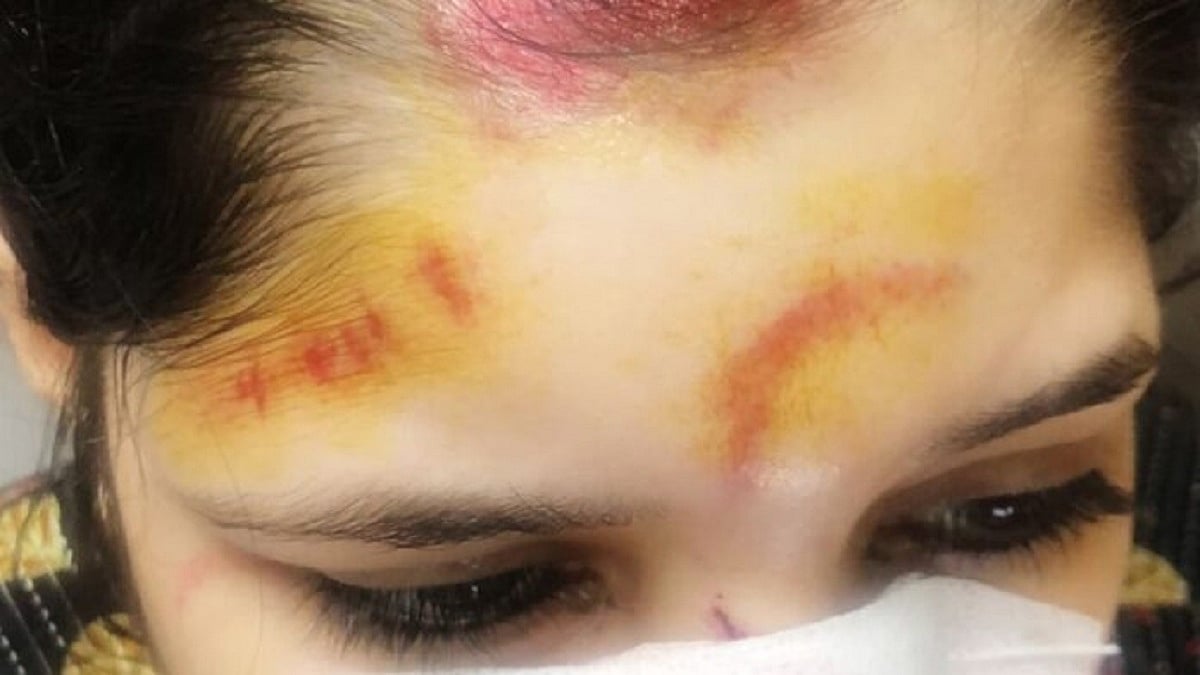 Delhi Crime: Woman Injured After Falling From Auto While Trying To Save Her iPhone From Snatchers In Saket