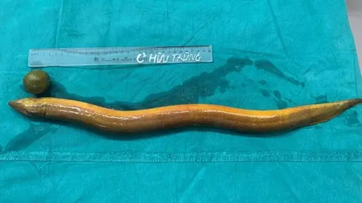 Shocker: Indian Man Inserts 2-Foot Long Live Eel Along With Lime Into His Rectum; Undergoes Emergency Surgery | X