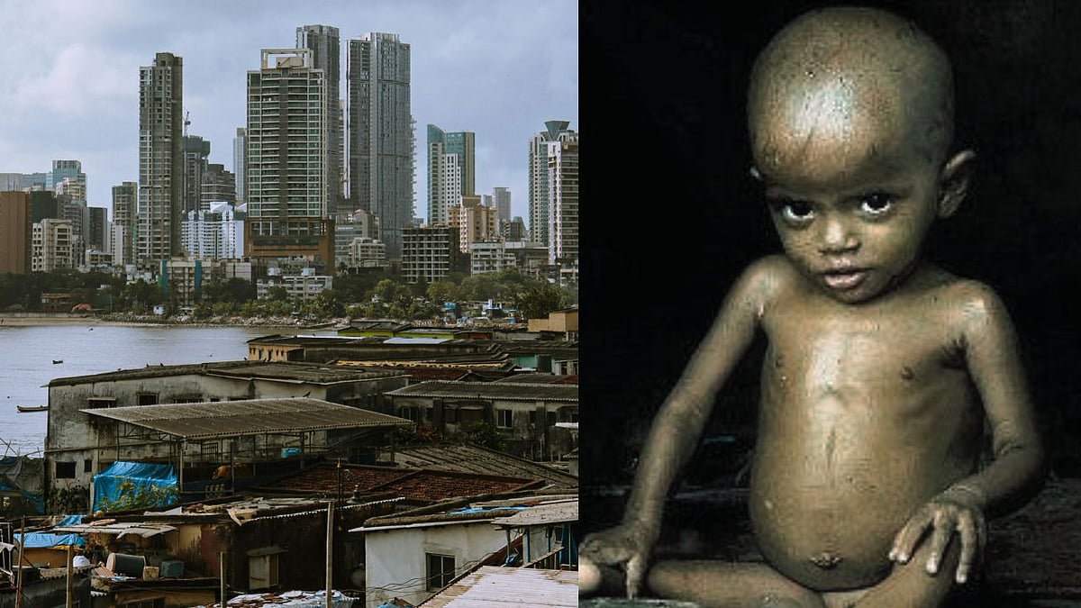 Mumbai: A Malnourished Mayanagri With Over 16,000 Children Affected