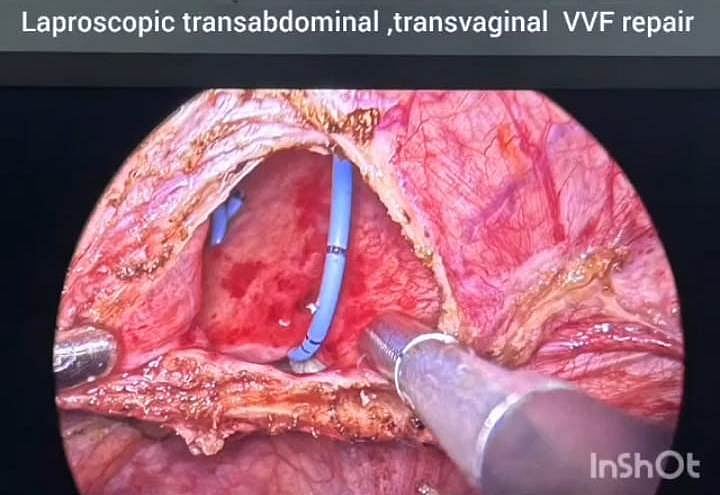 Rare Surgery With Advanced Laparoscopic Technique Done Free-Of-Cost At Indore's MY Hospital