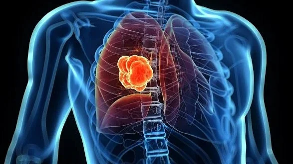 Mumbai: Govandi Lung Health Camp Reveals 20% Need Urgent Care, 65% Suffer Chronic Breathing Problems | representative pic