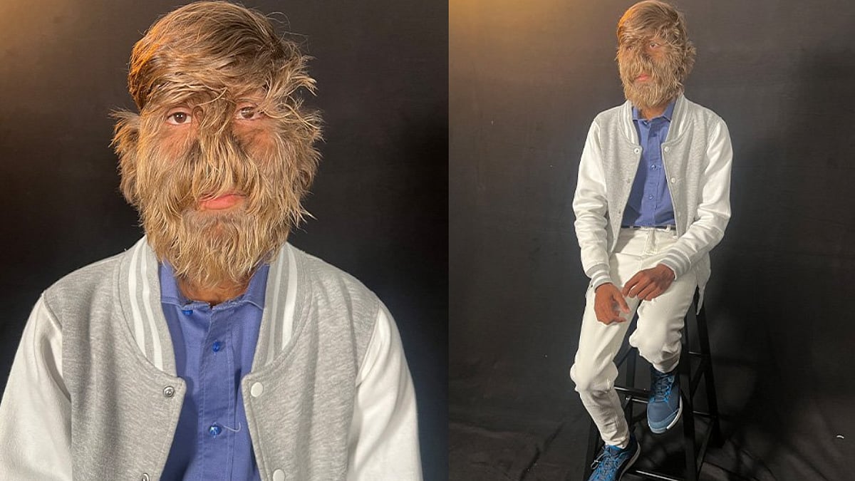 Werewolf Syndrome: 18-Year-Old Indian Boy Breaks Guinness World Record For Hairiest Face; Has 'One...