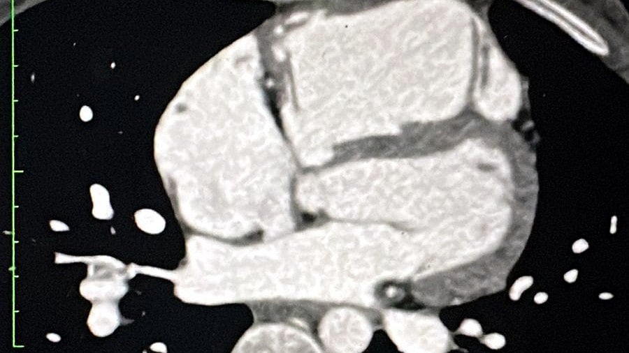 AIIMS Bhopal Performs Sinus Venosus ASD Closure With Hybrid Stent