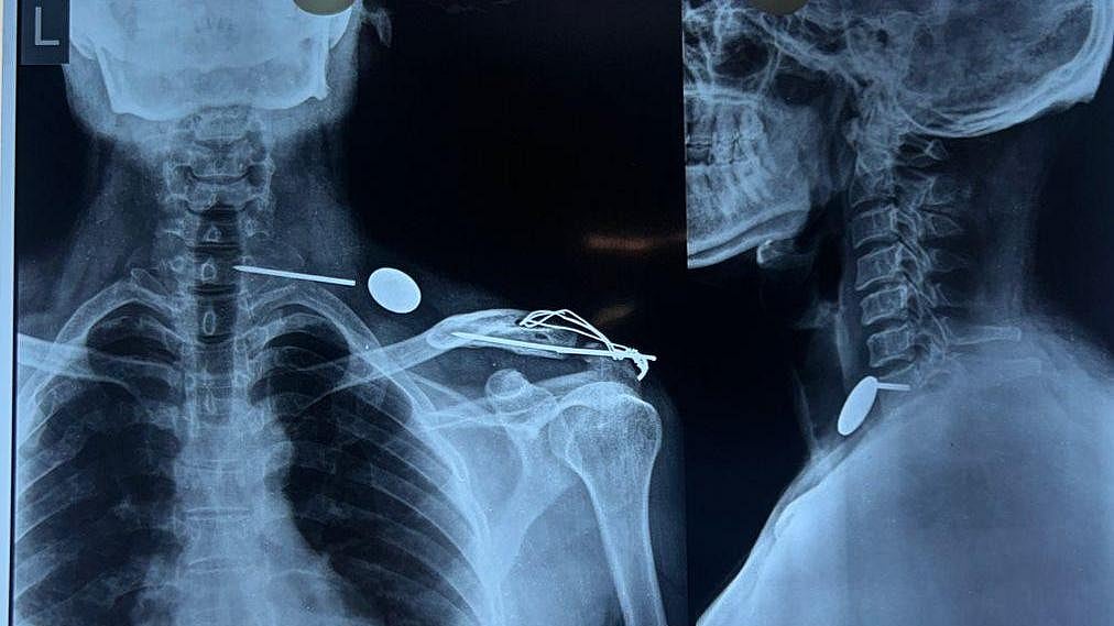 Indore News: Steel Nail Moves From Man’s Shoulder To Throat, Removed In 2.5-Hour Surgery