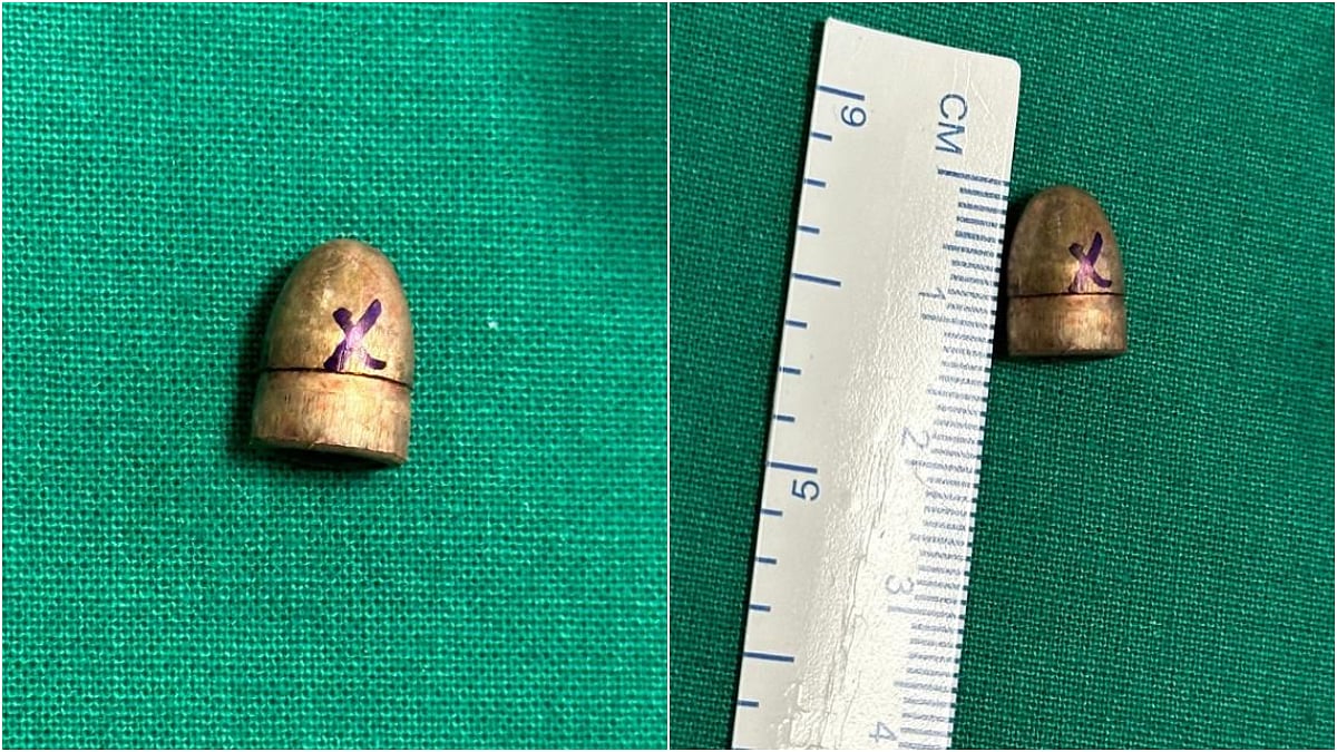 Doctors at J. J. Hospital remove a bullet from the skull base of a 55-year-old Malad man using advanced navigation technology