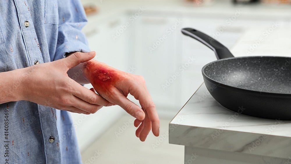 MP News: Woman Burnt With Hot Iron By In-Laws In Jabalpur; Tortured With Constant Taunts About Past...